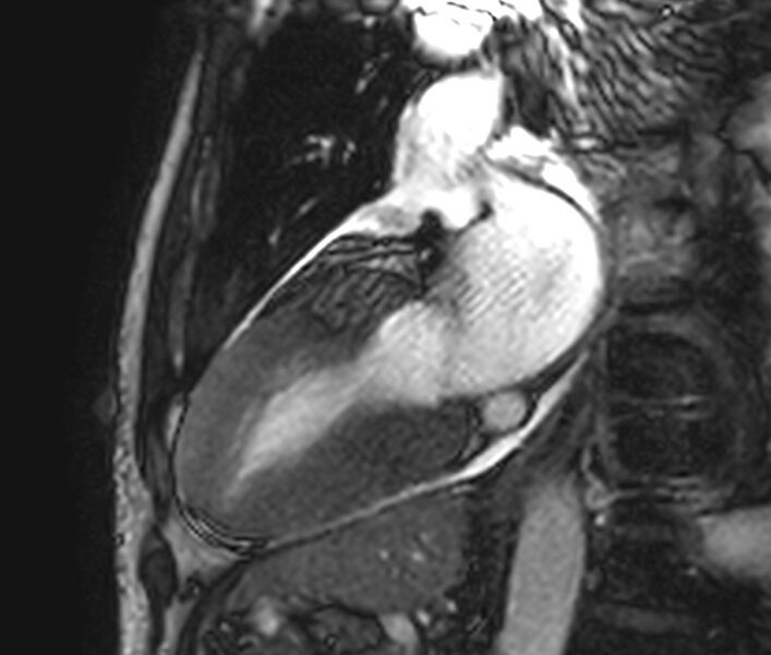 File:Cardiac amyloidosis (Radiopaedia 39736-42124 B 6).jpg