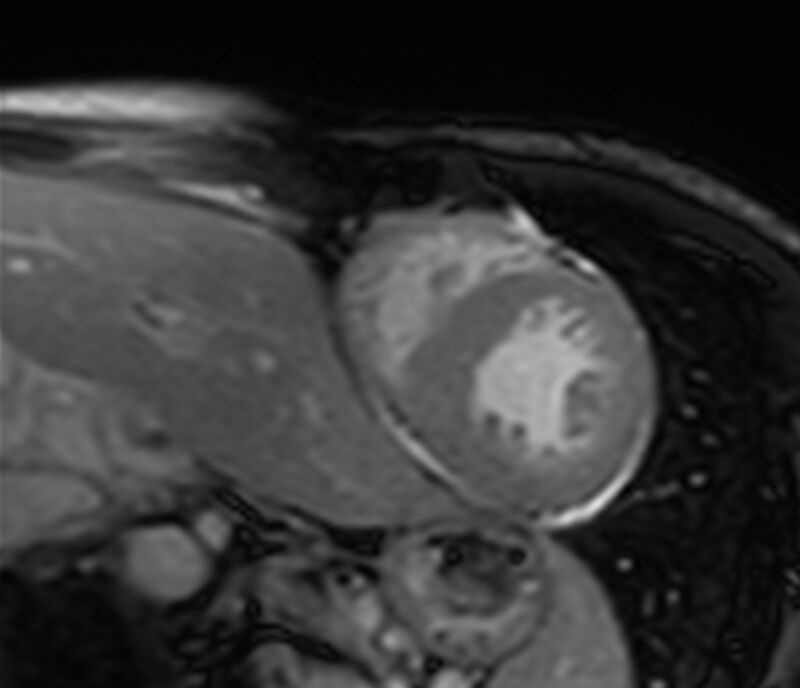 Cardiac amyloidosis (Radiopaedia 39736-42124 F 170).jpg