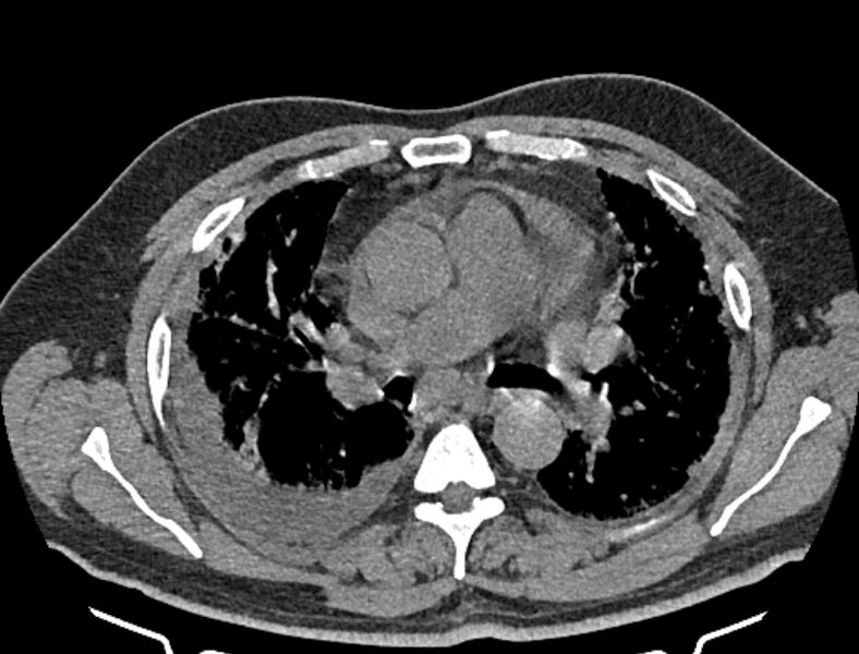 File:Cardiogenic pulmonary edema (Radiopaedia 68180-77678 Axial non-contrast 20).jpg