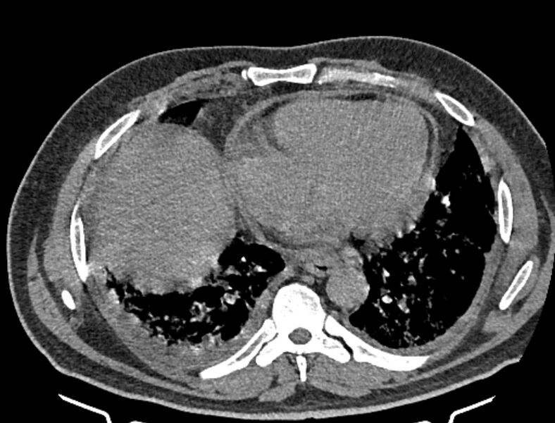 File:Cardiogenic pulmonary edema (Radiopaedia 68180-77678 Axial non-contrast 35).jpg