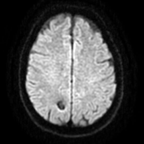 File:Cavernous hemangioma - brain (Radiopaedia 9773-10378 Axial DWI 1).jpg
