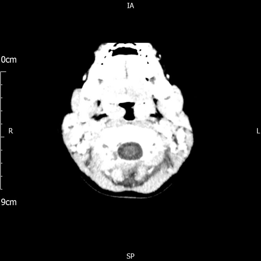 Cavernous sinus thrombosis (Radiopaedia 79414-92510 Axial Brain 29).jpg