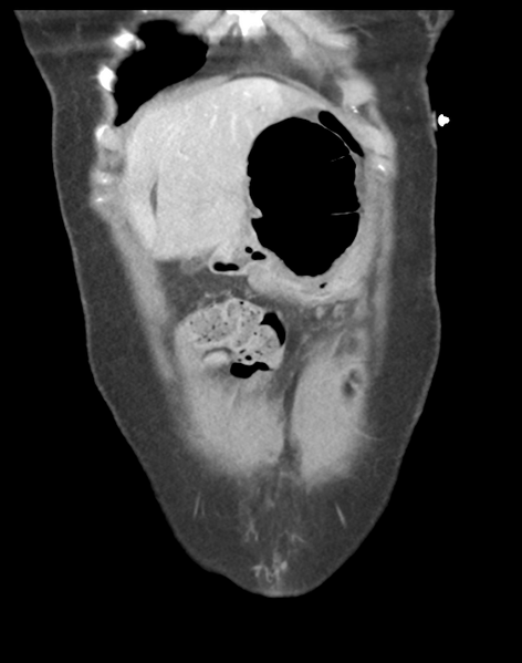 File:Cecum hernia through the foramen of Winslow (Radiopaedia 46634-51112 B 10).png