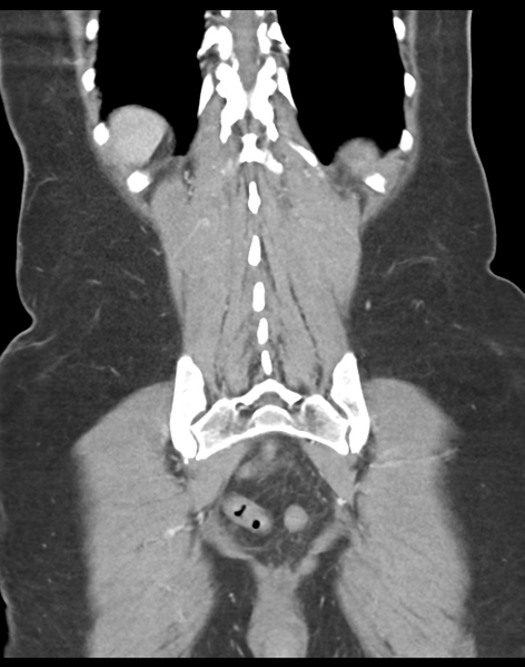 File:Cecum hernia through the foramen of Winslow (Radiopaedia 46634-51112 B 39).png