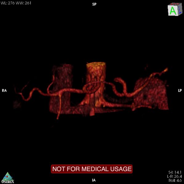 File:Celiac trunk variant anatomy - gastrohepatic trunk and splenic artery (Radiopaedia 38815-40995 B 14).jpg