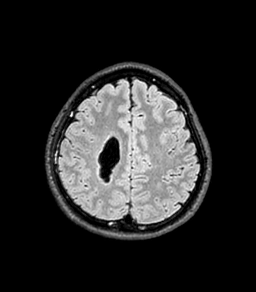 Central neurocytoma (Radiopaedia 79320-92380 Axial FLAIR 92).jpg
