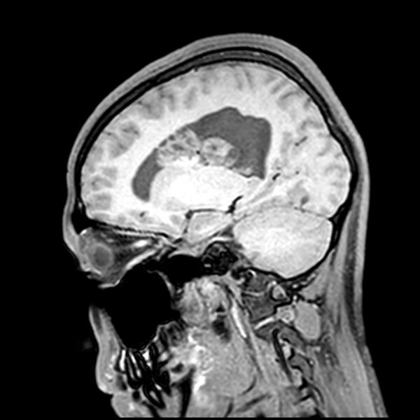 File:Central neurocytoma (Radiopaedia 79320-92380 Sagittal T1 164).jpg