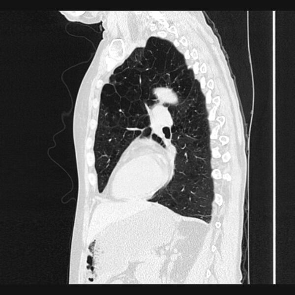 File:Centrilobular pulmonary emphysema (Radiopaedia 24495-24789 Sagittal lung window 51).jpg