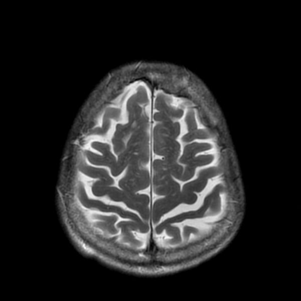File:Cerebellar ataxia with neuropathy and vestibular areflexia syndrome (CANVAS) (Radiopaedia 74283-85159 Axial T2 18).jpg