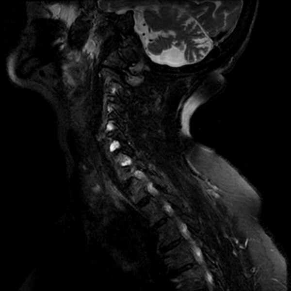 File:Cerebellar ataxia with neuropathy and vestibular areflexia syndrome (CANVAS) (Radiopaedia 74283-85159 Sagittal T2 fat sat 2).jpg