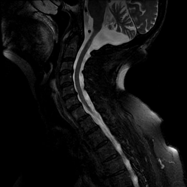 File:Cerebellar ataxia with neuropathy and vestibular areflexia syndrome (CANVAS) (Radiopaedia 74283-85159 Sagittal T2 fat sat 6).jpg