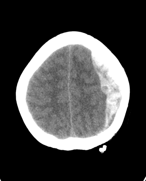 File:Cerebellar ependymoma complicated by post-operative subdural hematoma (Radiopaedia 83322-97737 Axial non-contrast 7).png