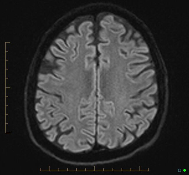 File:Cerebellar gangliocytoma (Radiopaedia 65377-74422 Axial DWI 28).jpg