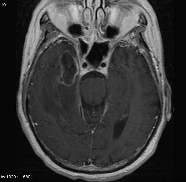 File:Cerebral abscess and ventriculitis (Radiopaedia 5024-6885 Axial T1 C+ 1).jpg
