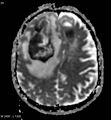 Cerebral abscesses secondary to contusions (Radiopaedia 5201-6968 Axial ADC 1).jpg