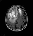 Cerebral abscesses secondary to contusions (Radiopaedia 5201-6968 Axial FLAIR 4).jpg