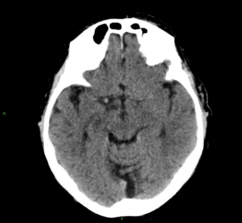 Cerebral amyloid angiopathy-associated lobar intracerebral hemorrhage (Radiopaedia 58376-65511 Axial non-contrast 35).jpg