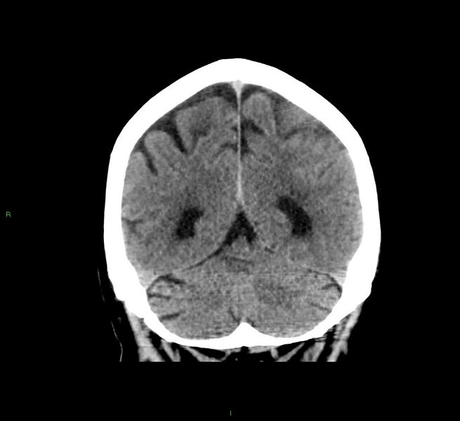 File:Cerebral amyloid angiopathy-associated lobar intracerebral hemorrhage (Radiopaedia 58376-65511 Coronal non-contrast 20).jpg