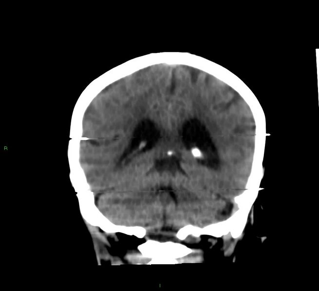 File:Cerebral amyloid angiopathy-associated lobar intracerebral hemorrhage (Radiopaedia 58377-65514 Coronal non-contrast 24).jpg
