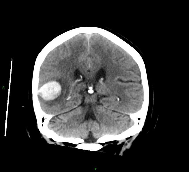 File:Cerebral amyloid angiopathy-associated lobar intracerebral hemorrhage (Radiopaedia 58378-65516 Coronal non-contrast 25).jpg