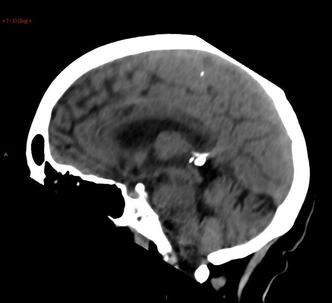 File:Cerebral amyloid angiopathy-associated lobar intracerebral hemorrhage (Radiopaedia 58378-65518 C 33).jpg