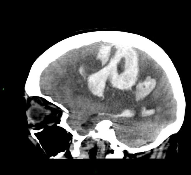 File:Cerebral amyloid angiopathy-associated lobar intracerebral hemorrhage (Radiopaedia 58379-65519 C 19).jpg