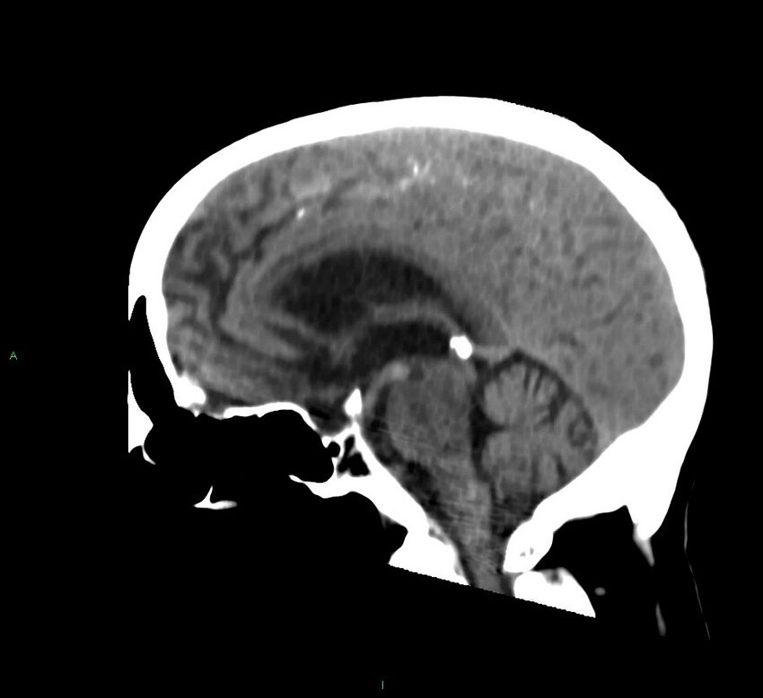 Cerebral amyloid angiopathy-associated lobar intracerebral hemorrhage (Radiopaedia 58530-65688 C 28).jpg
