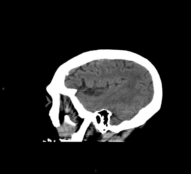 File:Cerebral amyloid angiopathy-associated lobar intracerebral hemorrhage (Radiopaedia 58560-65723 C 42).jpg