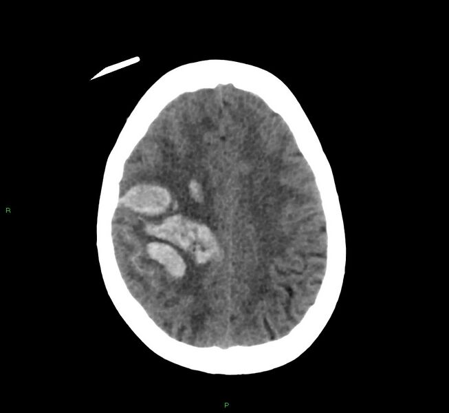 File:Cerebral amyloid angiopathy-associated lobar intracerebral hemorrhage (Radiopaedia 58566-65730 Axial non-contrast 15).jpg