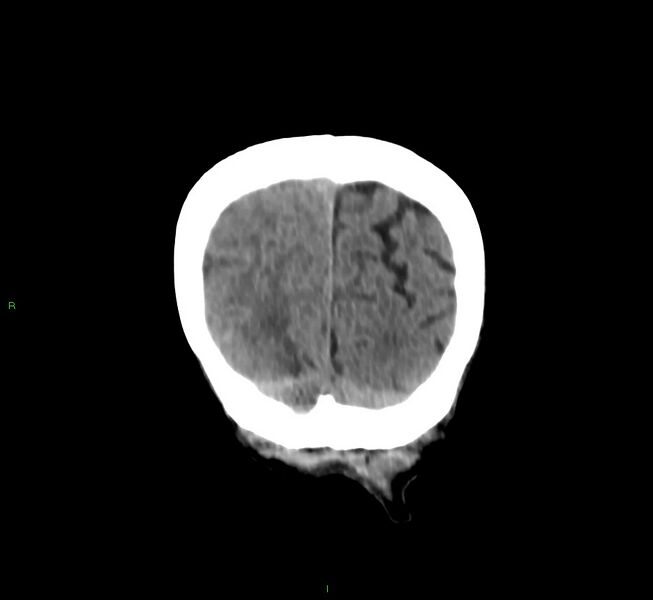 File:Cerebral amyloid angiopathy-associated lobar intracerebral hemorrhage (Radiopaedia 58758-65980 Coronal non-contrast 11).jpg
