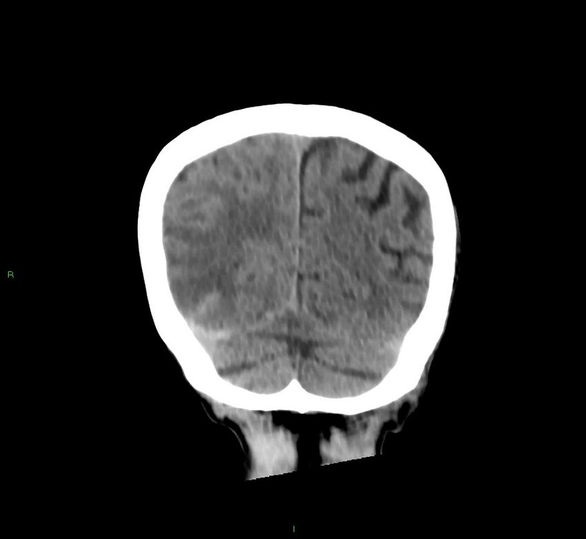 Cerebral amyloid angiopathy-associated lobar intracerebral hemorrhage (Radiopaedia 58758-65980 Coronal non-contrast 15).jpg
