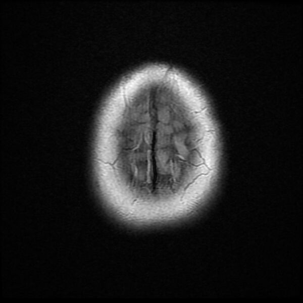File:Cerebral cavernous malformation (Radiopaedia 44301-47942 Axial FLAIR 20).jpg