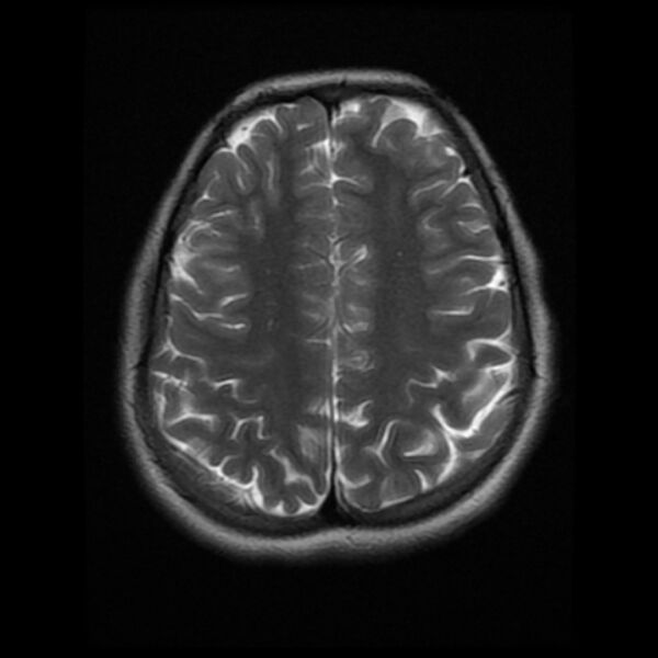 File:Cerebral cavernous malformation (Radiopaedia 44301-47942 Axial T2 16).jpg