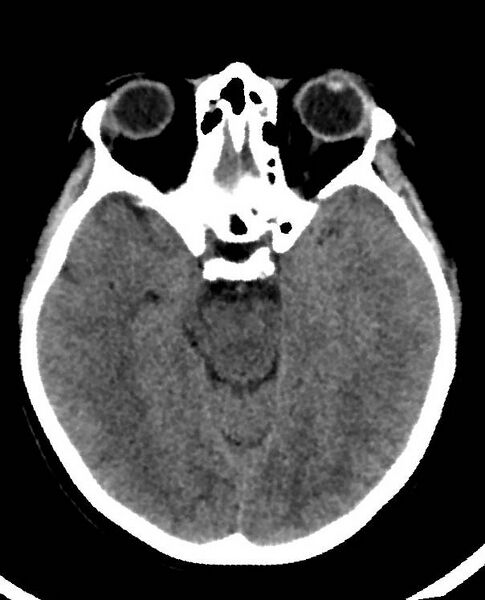 File:Cerebral edema due to severe hyponatremia (Radiopaedia 89826-106938 Axial non-contrast 41).jpg