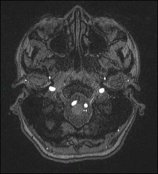 File:Cerebral fat embolism (Radiopaedia 35022-36525 Axial TOF 16).jpg