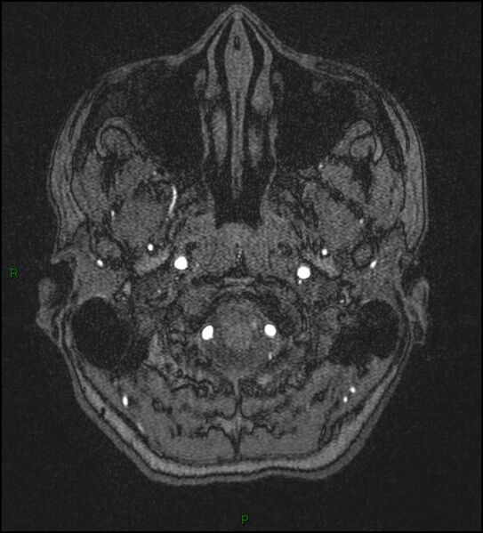 File:Cerebral fat embolism (Radiopaedia 35022-36525 Axial TOF 2).jpg