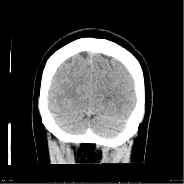 File:Cerebral hemorrhage secondary to arteriovenous malformation (Radiopaedia 33497-34561 Coronal non-contrast 48).jpg