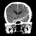 Cerebral hemorrhagic contusions (Radiopaedia 23145-23188 Coronal non-contrast 18).jpg