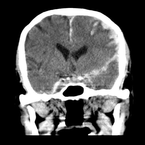 File:Cerebral hemorrhagic contusions (Radiopaedia 23145-23188 Coronal non-contrast 18).jpg