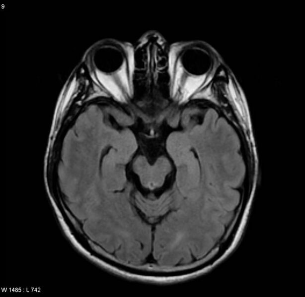File:Cerebral vasculitis (Radiopaedia 5131-6923 Axial FLAIR 3).jpg