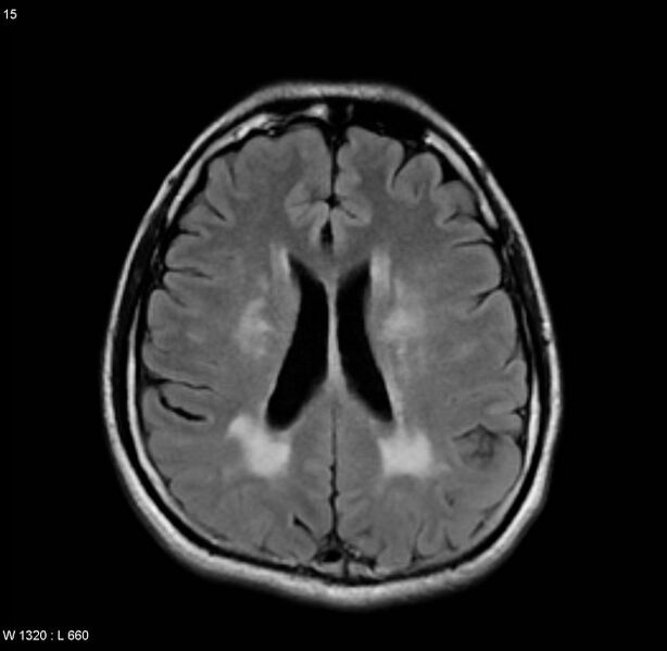 File:Cerebral vasculitis (Radiopaedia 5131-6923 Axial FLAIR 7).jpg