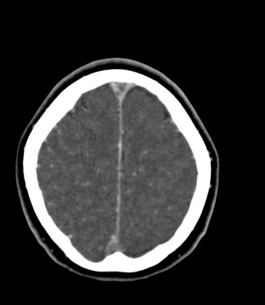 File:Cerebral venous sinus thrombosis (Radiopaedia 59224-66646 Axial C+ delayed 10).jpg