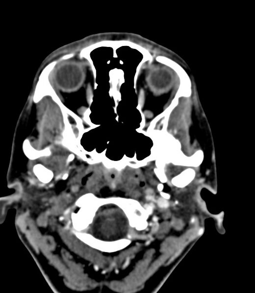 File:Cerebral venous sinus thrombosis (Radiopaedia 59224-66646 Axial C+ delayed 47).jpg