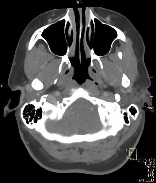 File:Cerebral venous sinus thrombosis (Radiopaedia 91329-108965 Axial venogram 13).jpg
