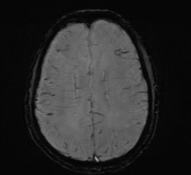 File:Cerebral venous thrombosis (Radiopaedia 71207-81504 Axial SWI 35).jpg