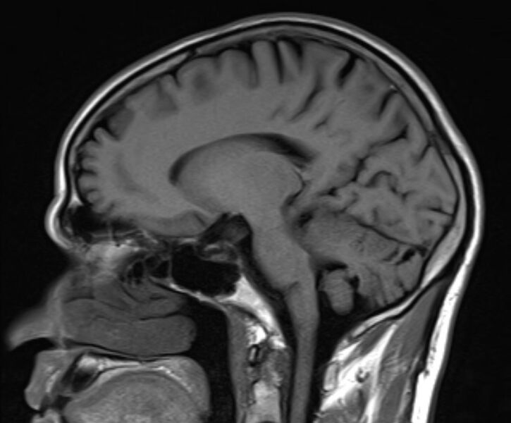 File:Cerebral venous thrombosis (Radiopaedia 71207-81504 Sagittal T1 11).jpg