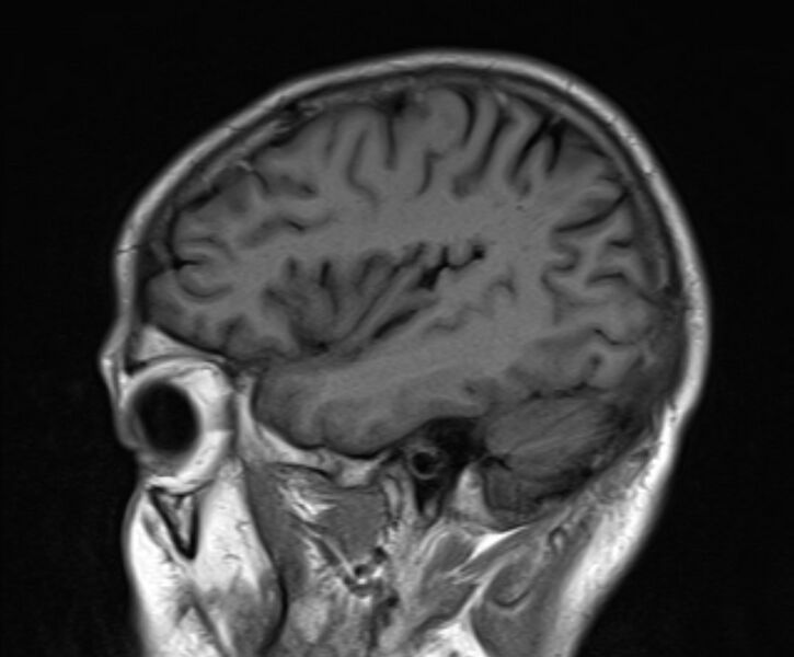 File:Cerebral venous thrombosis (Radiopaedia 71207-81504 Sagittal T1 20).jpg