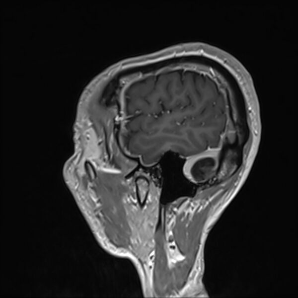 File:Cervical dural CSF leak on MRI and CT treated by blood patch (Radiopaedia 49748-54995 G 110).jpg