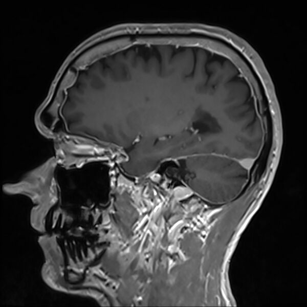 File:Cervical dural CSF leak on MRI and CT treated by blood patch (Radiopaedia 49748-54995 G 32).jpg