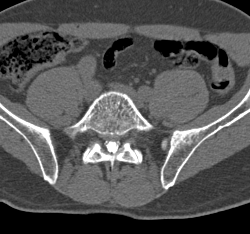 Cervical dural CSF leak on MRI and CT treated by blood patch (Radiopaedia 49748-54996 B 115).png